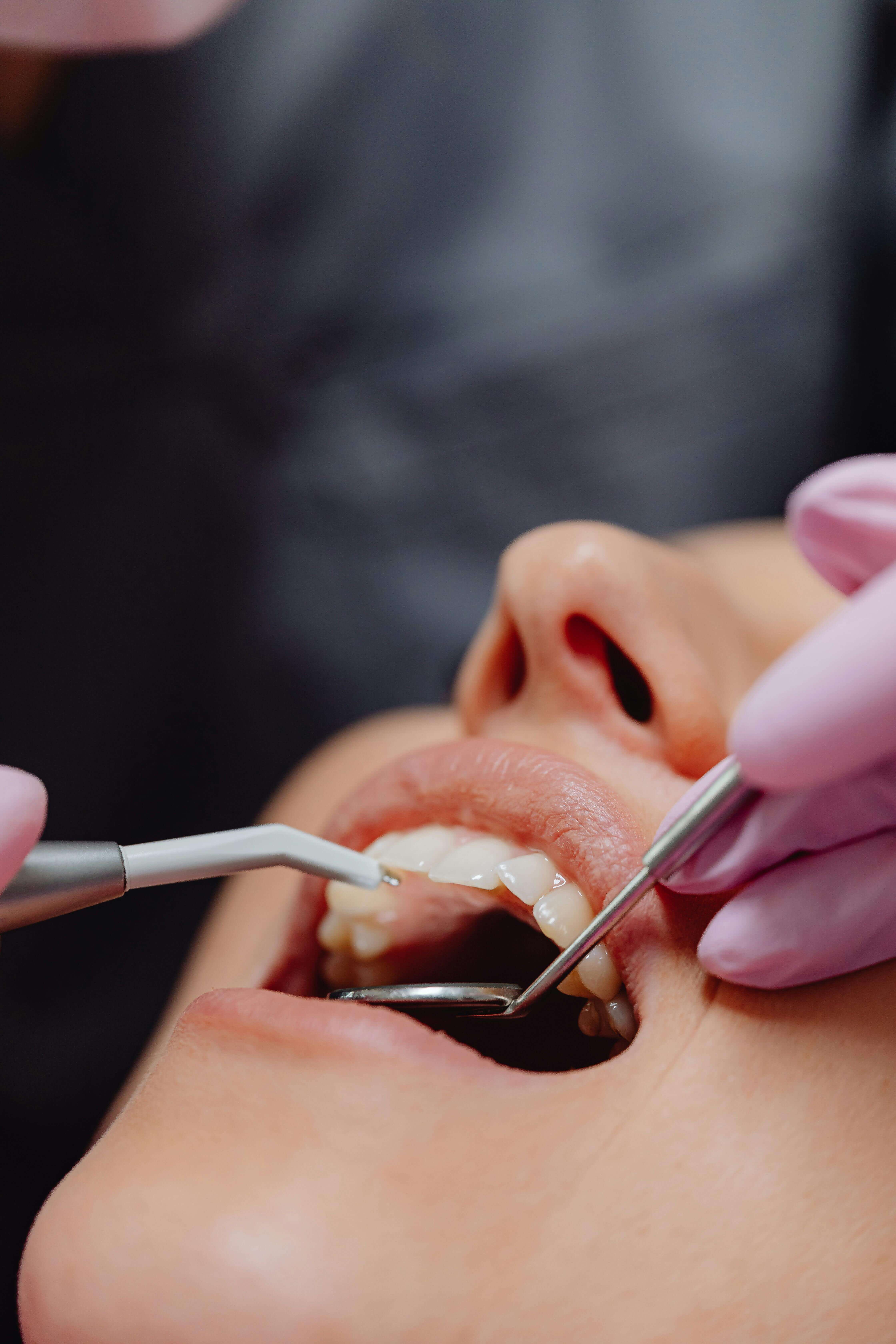 Dental Implants